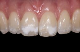 Białe plamy na zębach? Odkryj ich tajemnicę i przywróć blask swojemu uśmiechowi!